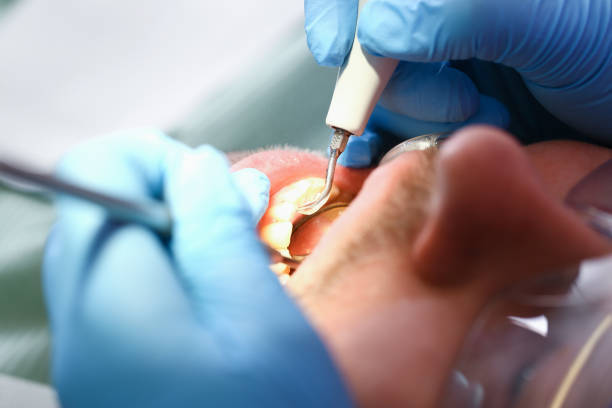 Best Emergency Dental Care for Broken or Chipped Teeth in Forestville, CA